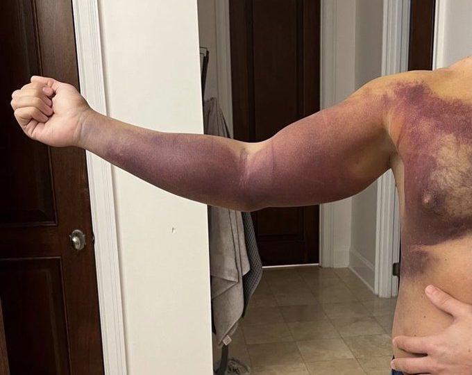 Cody Rhodes bruised chest and arm